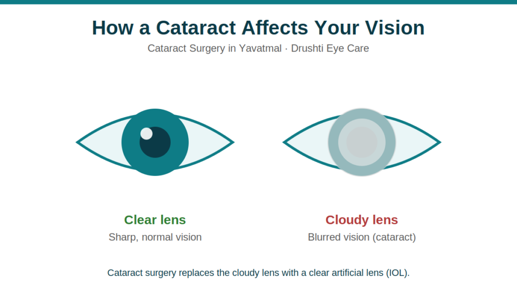 diabetic-retinopathy-yavatmal.png