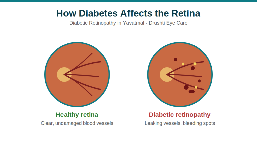 diabetic-retinopathy-yavatmal.png