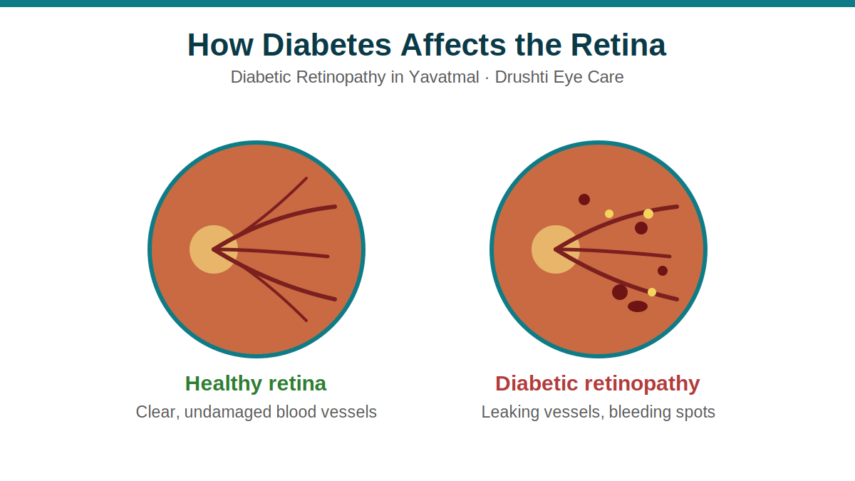 diabetic-retinopathy-yavatmal.png